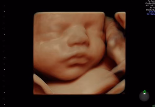 Anne Karnındaki Bebeğin Anatomik Yapısını Gerçeğe En Yakın Görüntü ile Veren Hd4d Ultrason Sistemi Yakın Doğu Üniversitesi Hastanesi’nde