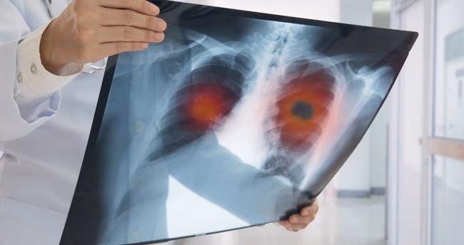 Akciğer Kanserinde Yeni Tedavi Yöntemleri Sağ Kalım Süresini Artırıyor