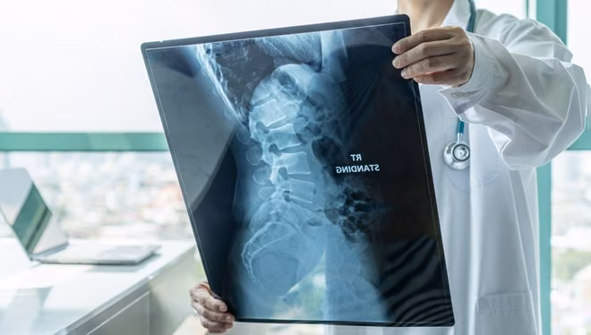 Ankilozan Spondilit Nedir? Ankilozan Spondilit Belirtileri ve Ankilozan Spondilit Tedavisi Nelerdir?